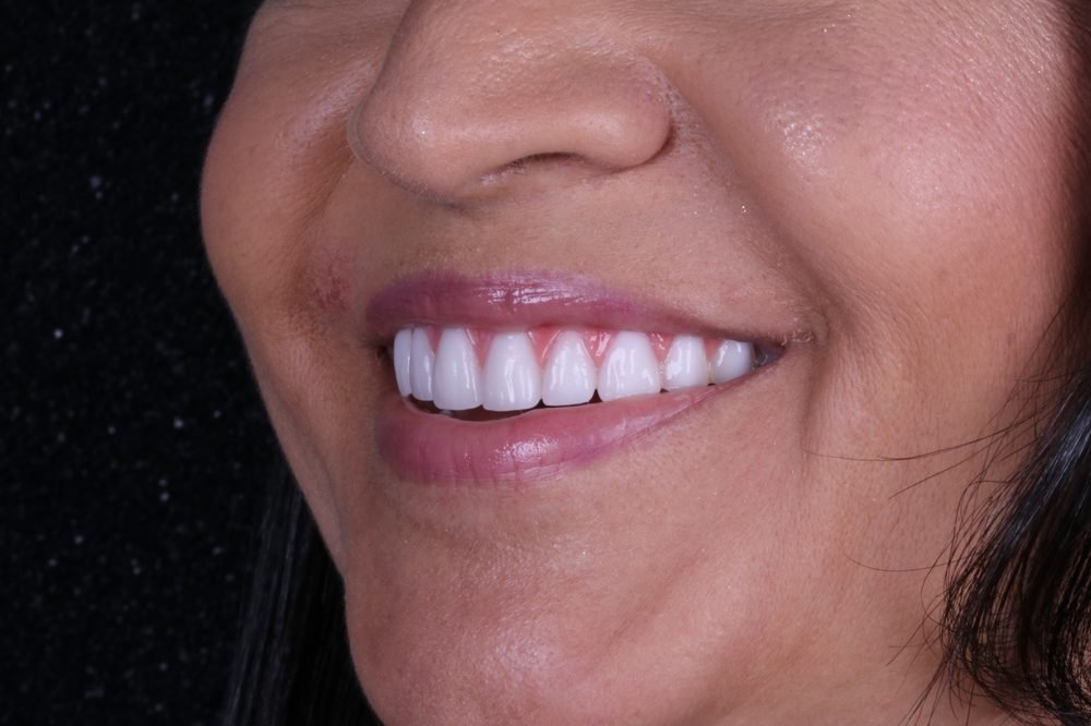 Detalhe de sorriso com lente de contato dental