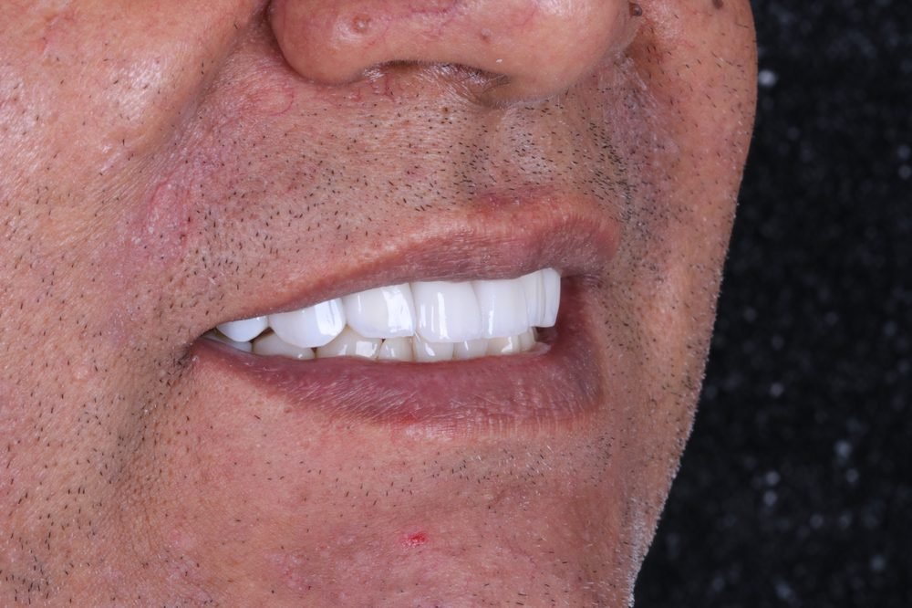 Detalhe de reabilitação com zircônia